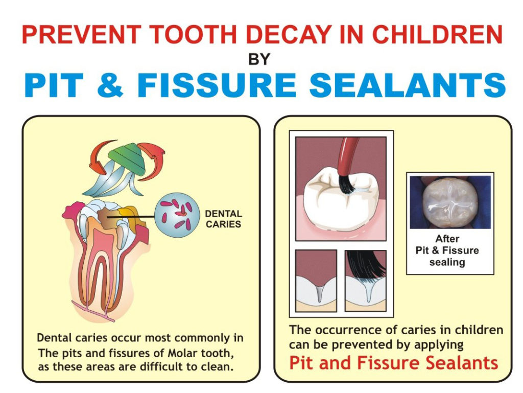 Top 9 Tips With tooth prosthesis